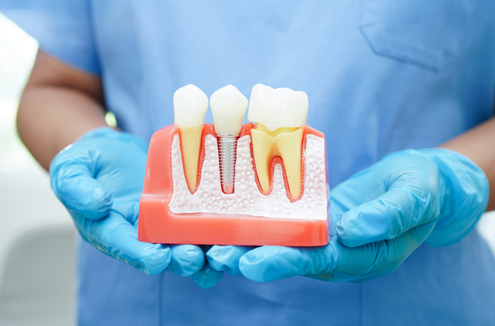 5 Ways Periodontics And Implant Dentistry Improve Oral Health